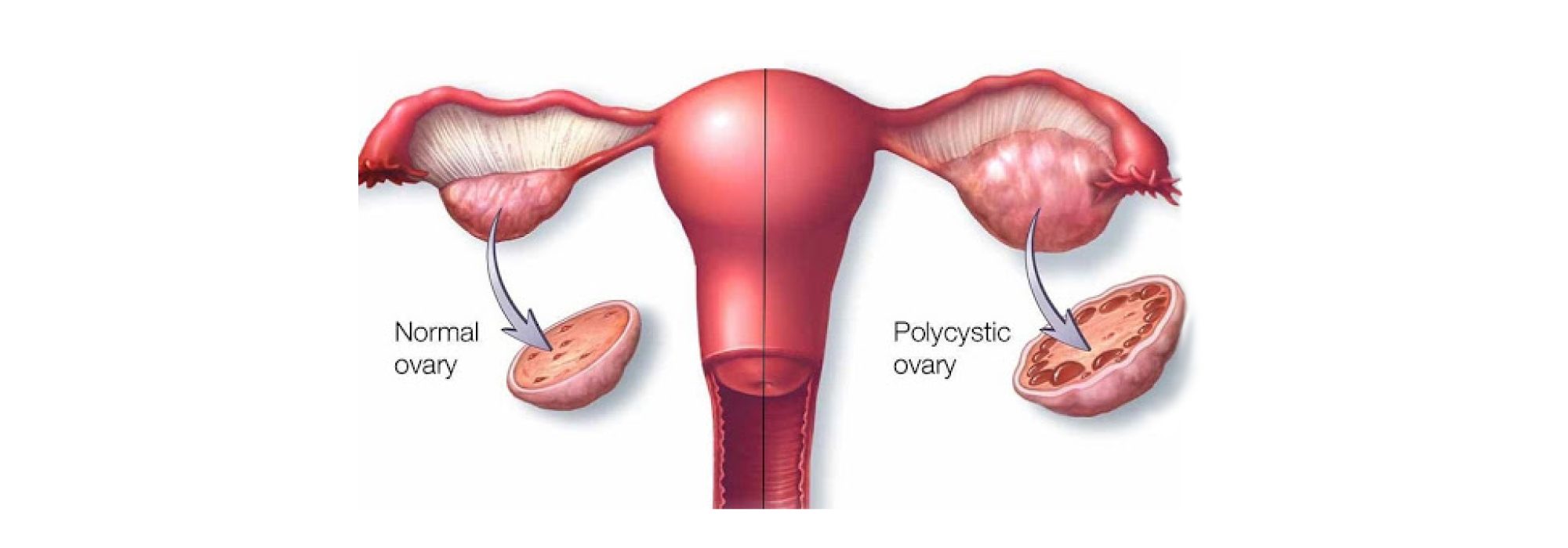 Pcod treatment in ghansoli